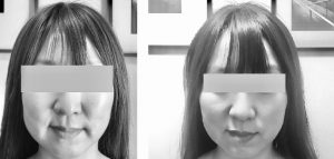 小顔になりたい30代