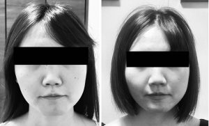 顔の歪みを治したい20代