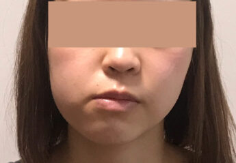 顔の左右非対称を治したい 顔ドック