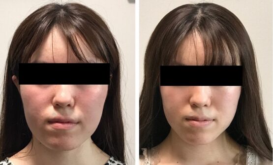 小顔矯正の効果を東京で求める方へ 歯科医院と提携している顔ドック