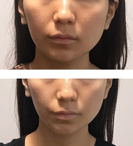 小顔矯正の効果を維持する方法 顔専門矯正サロン 顔ドック