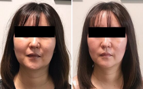 小顔矯正の効果を長く維持する方法 小顔矯正と顔の歪み矯正の顔ドック