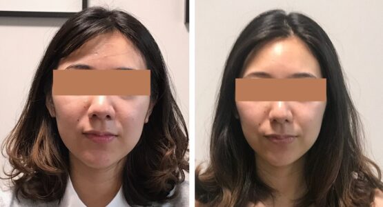 小顔矯正の効果を維持する方法 顔専門矯正サロン 顔ドック