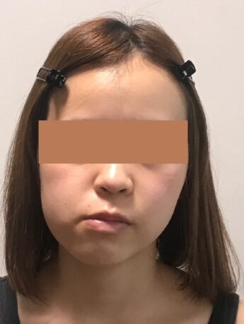 顎変形症と診断された。顔ドックで治してください。