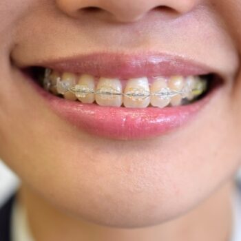 歯列矯正と顔の歪みの関係性