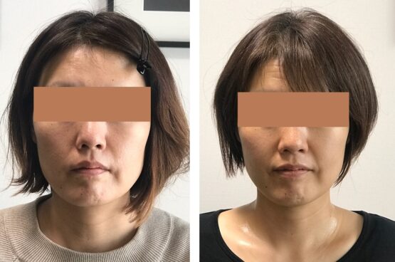 エラ張リ ひどいエラ張り顔も矯正で解消させる顔ドック