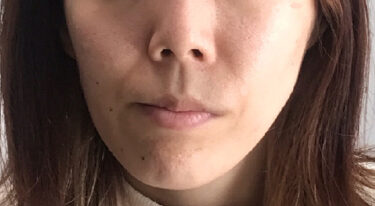 顔の歪みや左右非対称を治す 歪み矯正の顔ドック