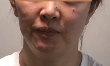 顔のたるみがひどい ブルドック顔を改善する 顔ドック