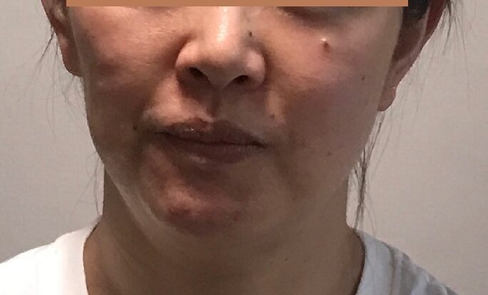 本気で若返りたい顔 でも整形はしたくない