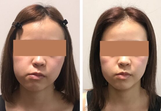 顎変形症手術 顔の変化18歳