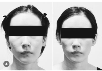 コルギは本当に顔の歪みに効果があります