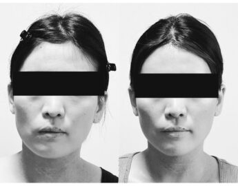 コルギは本当に顔の歪みに効果がありますか？