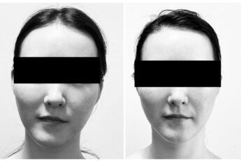 小顔になりたい人に骨気（コルギ）はおすすめです