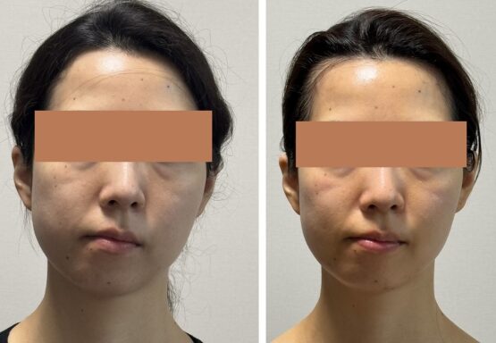 外科手術をしないで顔の歪みを改善する『顔ドック』の効果
