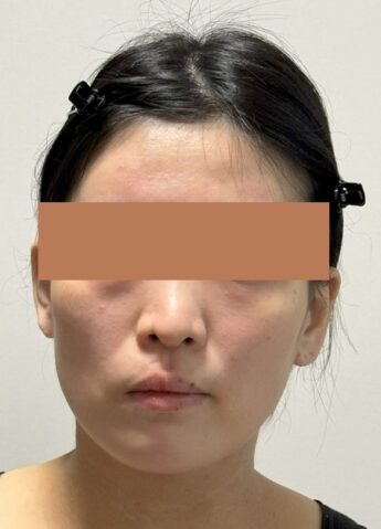 外科手術をしないで顔の歪みを治す顔ドック