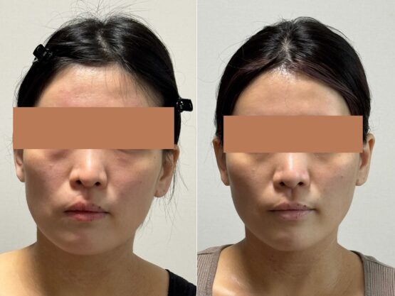 外科手術をしないで顔の歪みを治った顔ドック