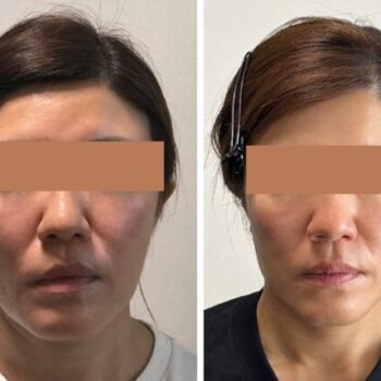 歪んだ顔は老けて見える｜骨に適度な負荷をかける手技で若返る「顔ドック」