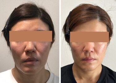 歪んだ顔は老けて見える｜骨に適度な負荷をかける手技で若返る「顔ドック」