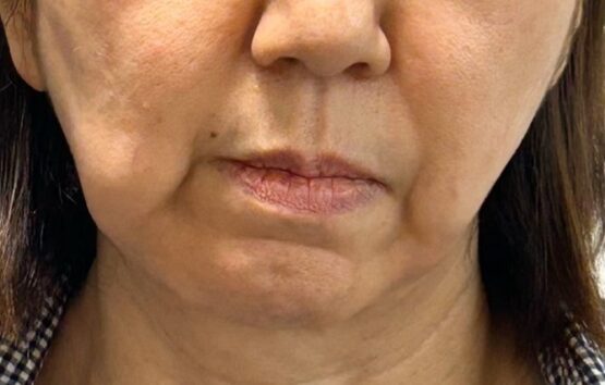 老けて見える最大の原因は 加齢ではなく顔の歪み