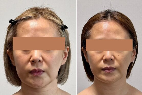 顔の骨痩せ改善_顔面骨構造研究家 林幸千代
