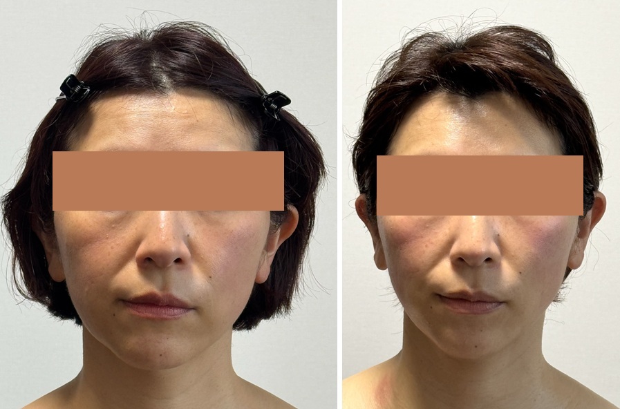 顔面骨構造の左右差による顔の歪み比較_顔面骨構造研究家 林幸千代