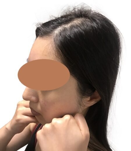 小顔矯正 セルフケア_顔ドック®