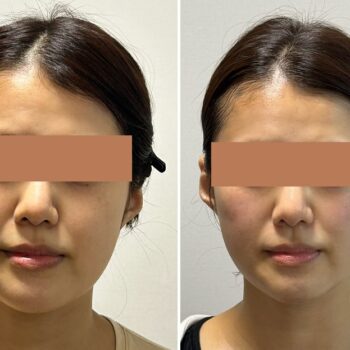 小顔矯正とは？顔の歪みや左右差にも着目する林メソッド™