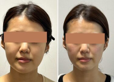 小顔矯正とは？顔の歪みや左右差にも着目する林メソッド™