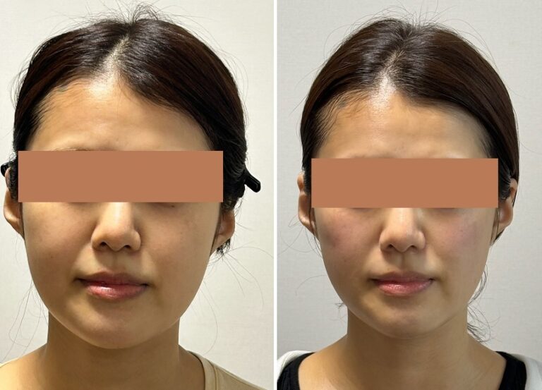 小顔矯正とは？顔の歪みや左右差、老け顔にも着目する林メソッド™