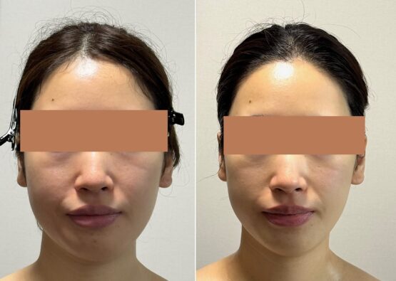顔の歪み30代女性症例_顔面骨構造研究家 林幸千代