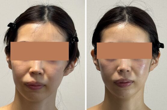 顔の歪みとは？左右非対称が生じる主な要因
